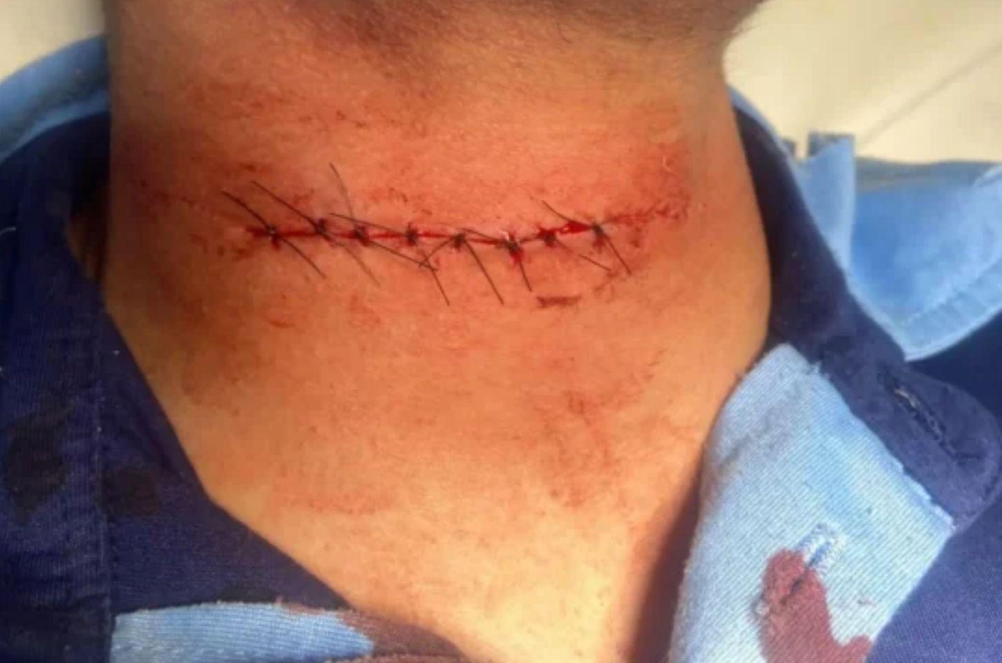 Jovem leva oito pontos no pescoço após ser atingido por linha com cerol em Baixo Guandu